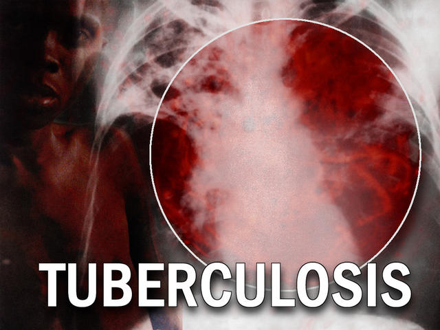 Origins of TB Traced Back To Humans
